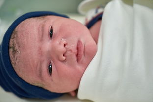 怀孕妊娠合并新生儿Sly综合征怎么酶替代_